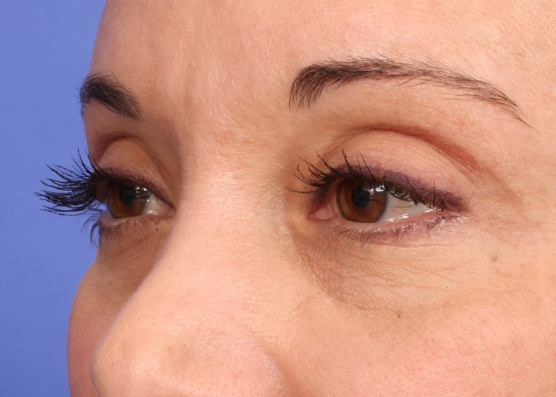 Eyelid Surgery Before & After Image
