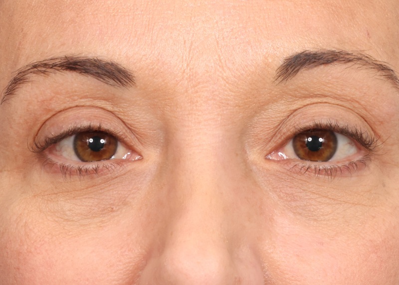 Eyelid Surgery Before & After Image