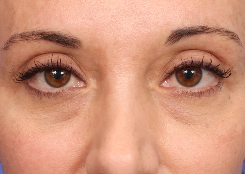 Eyelid Surgery Before & After Image