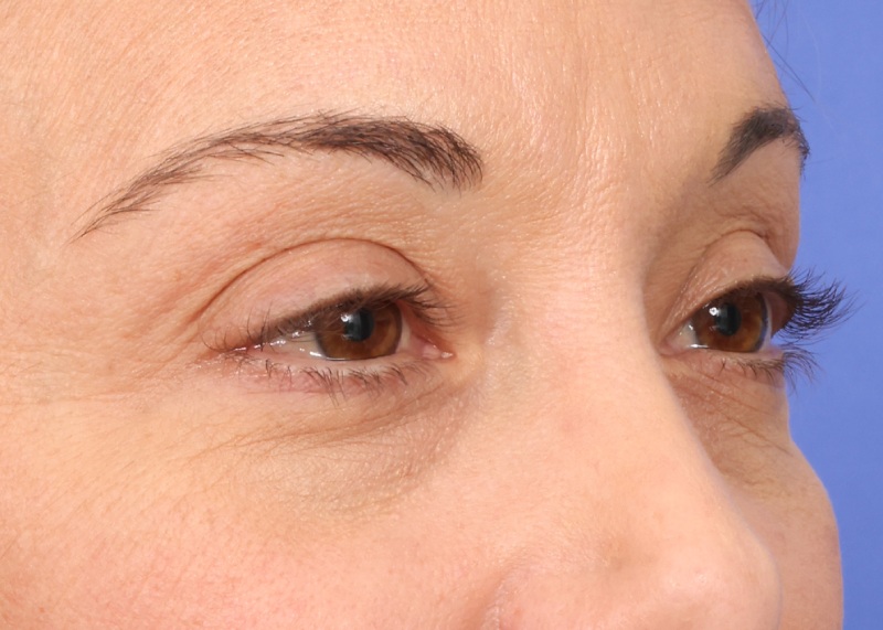 Eyelid Surgery Before & After Image