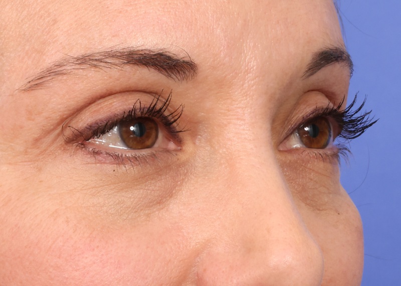 Eyelid Surgery Before & After Image