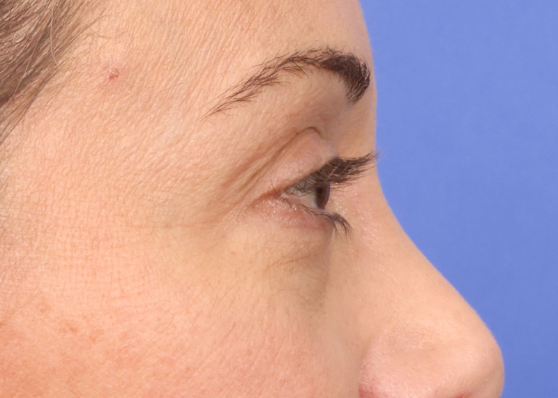 Eyelid Surgery Before & After Image