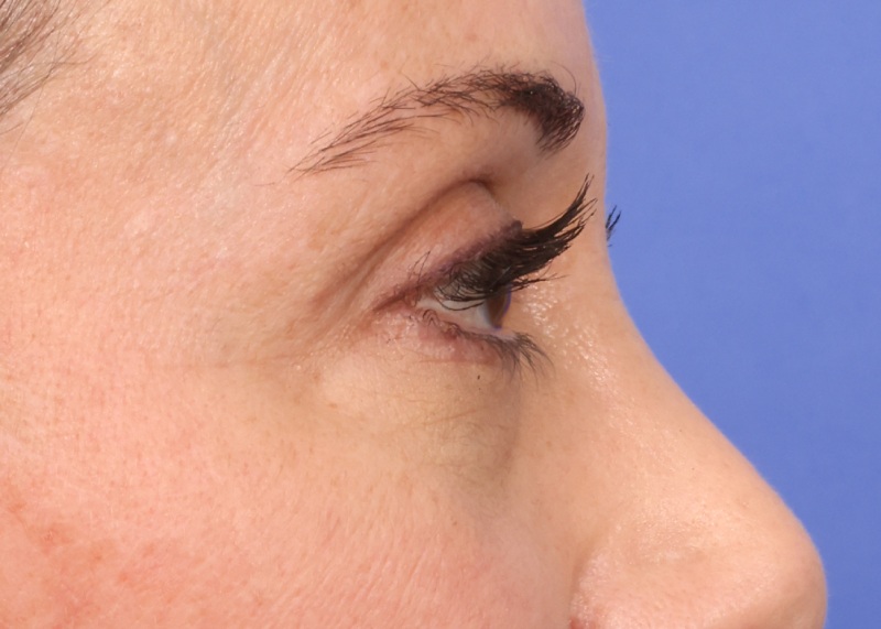 Eyelid Surgery Before & After Image