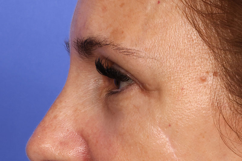 Eyelid Surgery Before & After Image