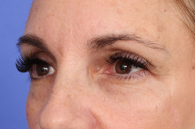 Eyelid Surgery Before & After Image