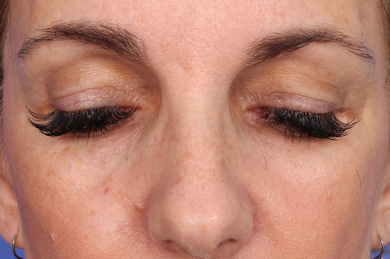 Eyelid Surgery Before & After Image