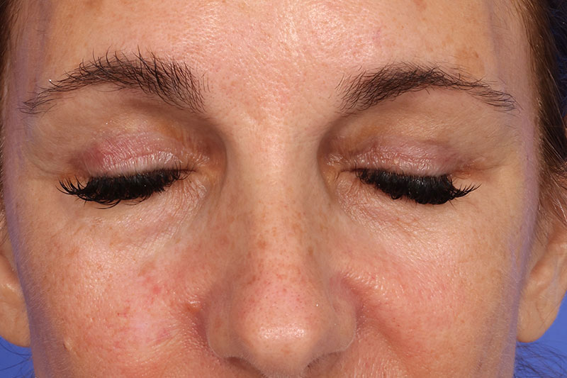 Eyelid Surgery Before & After Image