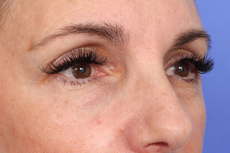 Eyelid Surgery Before & After Image