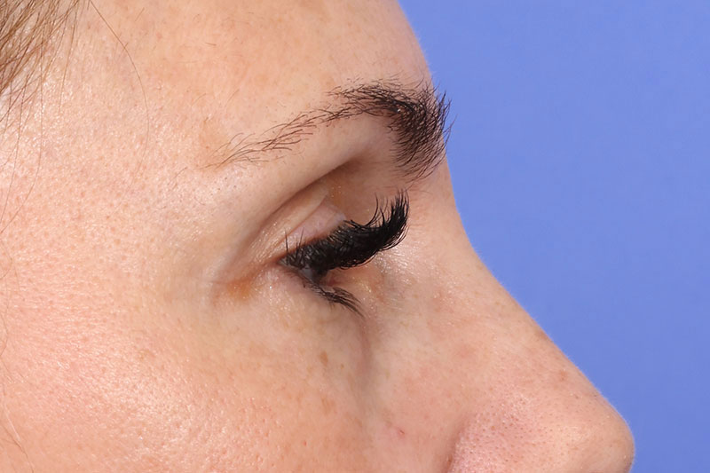 Eyelid Surgery Before & After Image