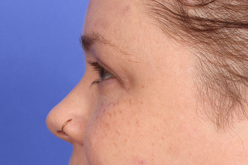 Eyelid surgery Before & After Image