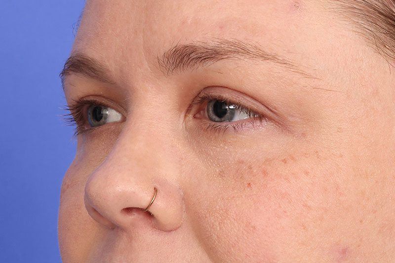 Eyelid Surgery Before & After Image