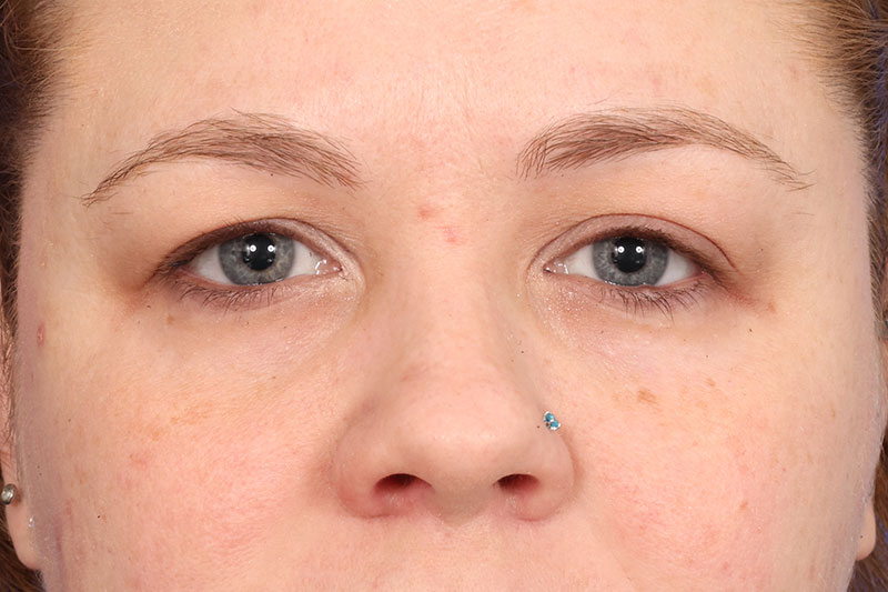 Eyelid Surgery Before & After Image