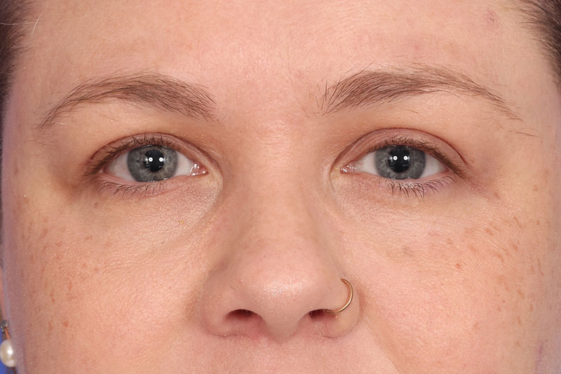 Eyelid Surgery Before & After Image