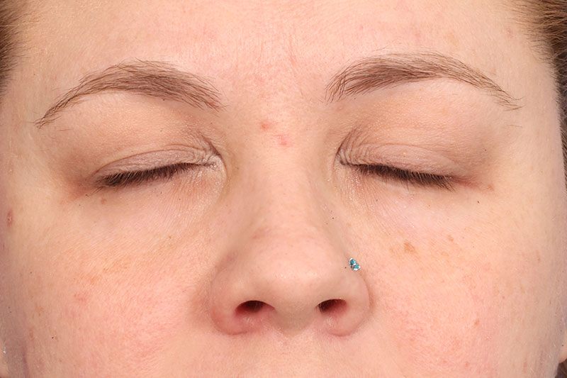 Eyelid Surgery Before & After Image