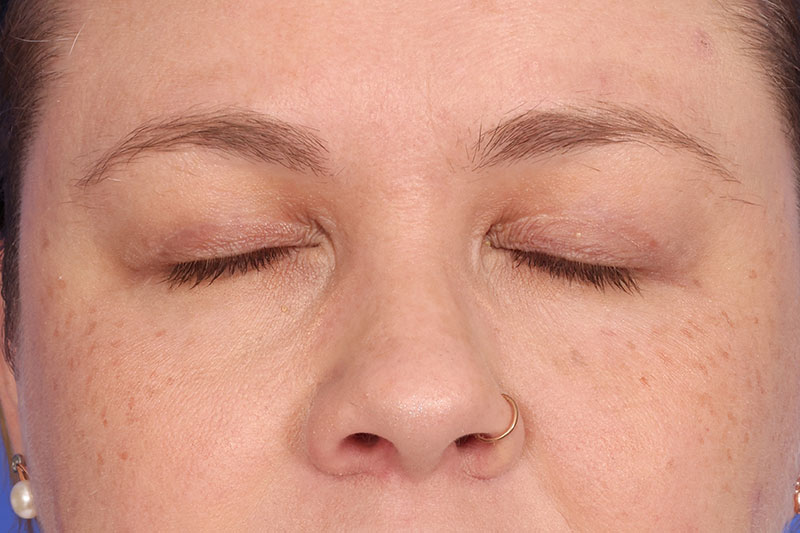 Eyelid Surgery Before & After Image