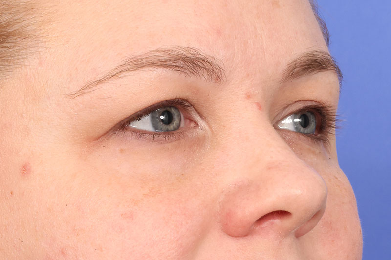 Eyelid Surgery Before & After Image