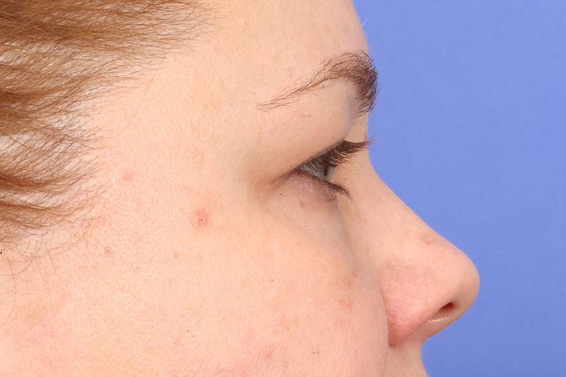 Eyelid Surgery Before & After Image