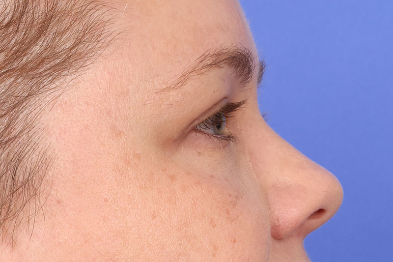 Eyelid Surgery Before & After Image