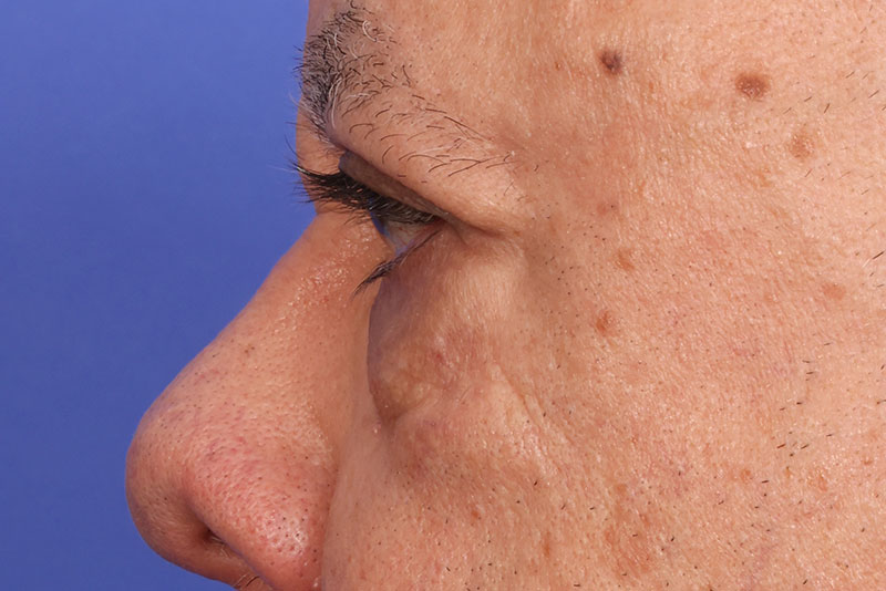 Eyelid surgery Before & After Image