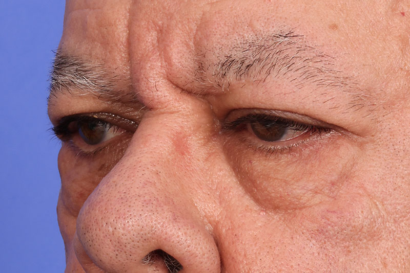 Eyelid Surgery Before & After Image