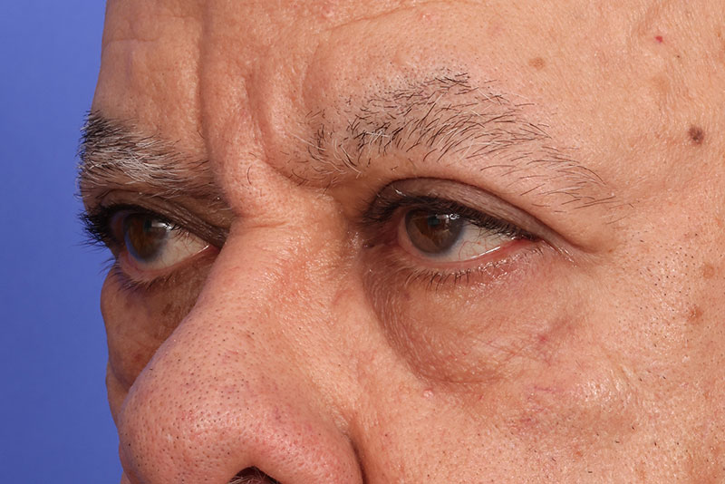 Eyelid Surgery Before & After Image