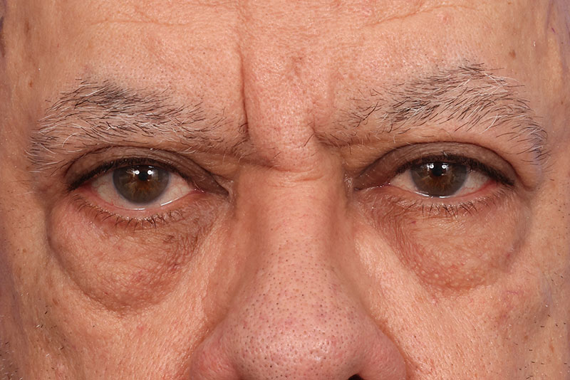 Eyelid Surgery Before & After Image