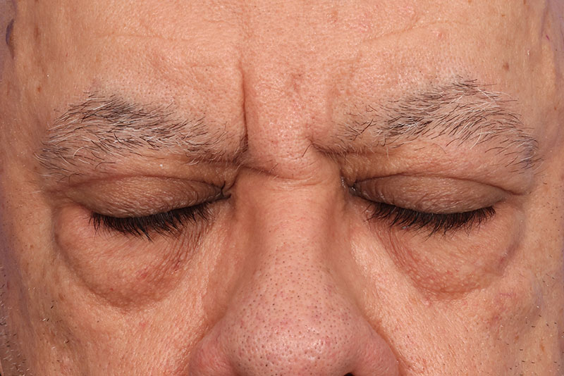 Eyelid Surgery Before & After Image
