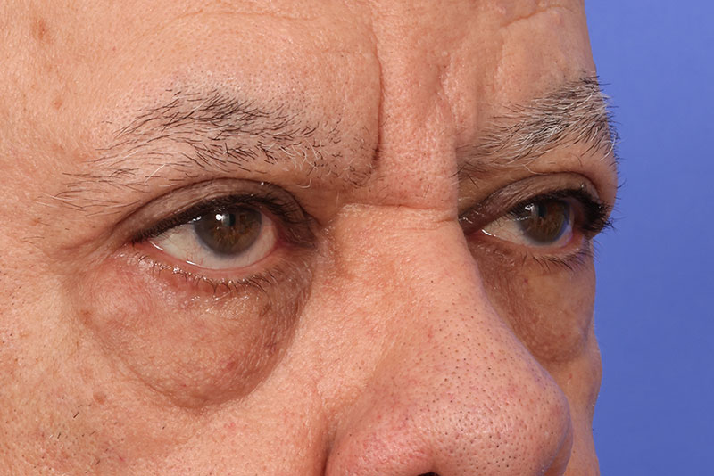 Eyelid Surgery Before & After Image