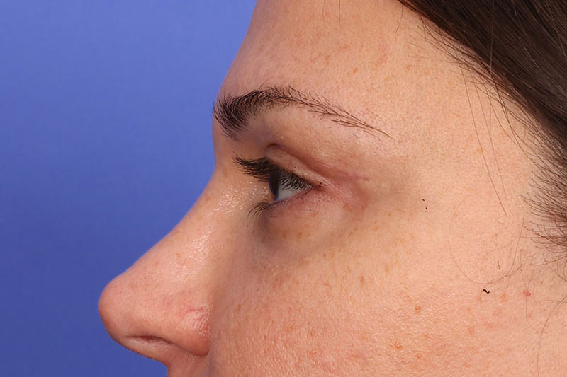Eyelid surgery Before & After Image