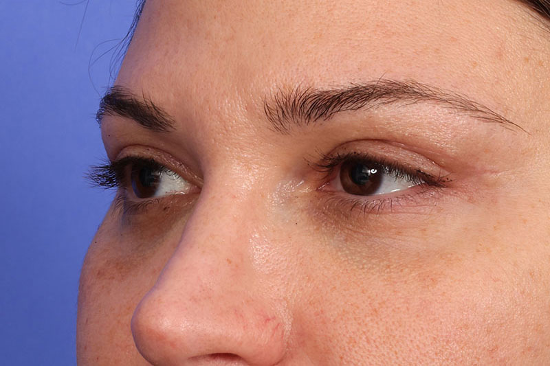 Eyelid Surgery Before & After Image