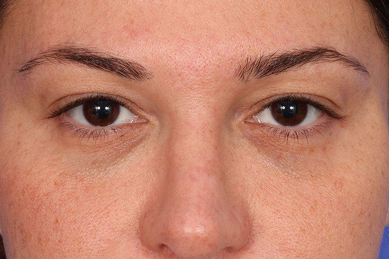 Eyelid Surgery Before & After Image