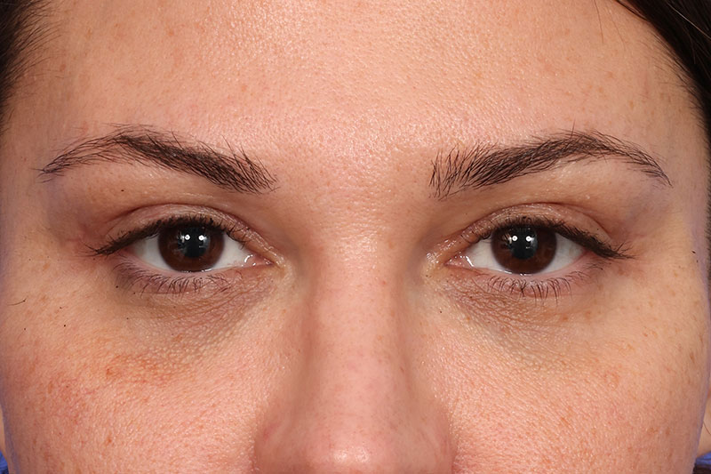 Eyelid Surgery Before & After Image