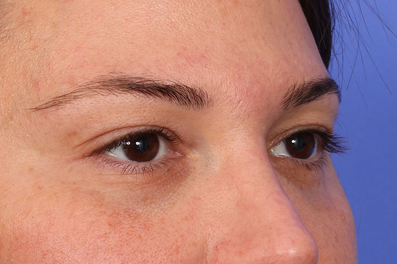 Eyelid Surgery Before & After Image
