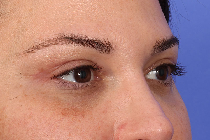 Eyelid Surgery Before & After Image