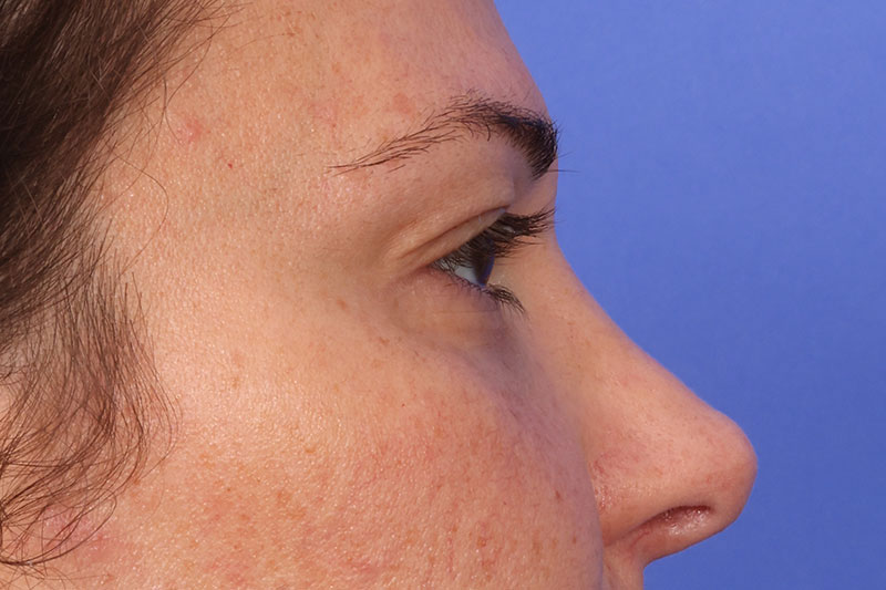 Eyelid Surgery Before & After Image
