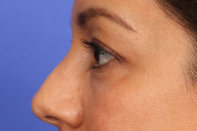 Eyelid surgery Before & After Image