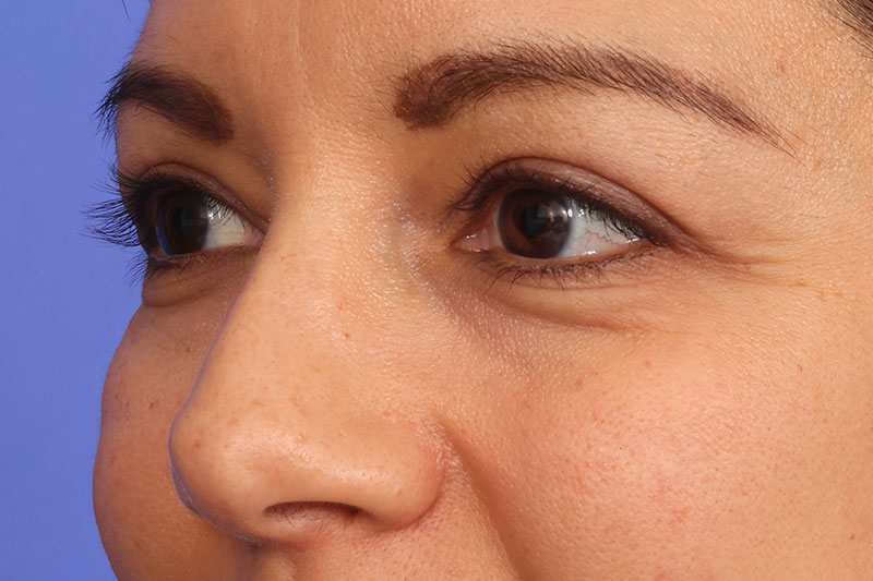Eyelid Surgery Before & After Image