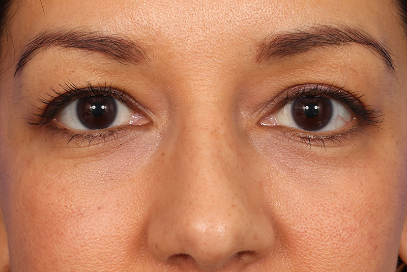 Eyelid Surgery Before & After Image