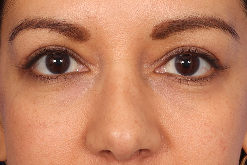Eyelid Surgery Before & After Image