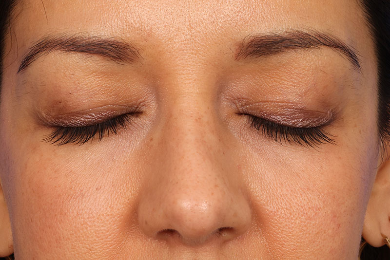 Eyelid Surgery Before & After Image