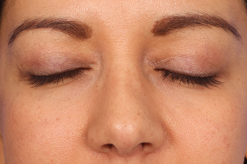 Eyelid Surgery Before & After Image