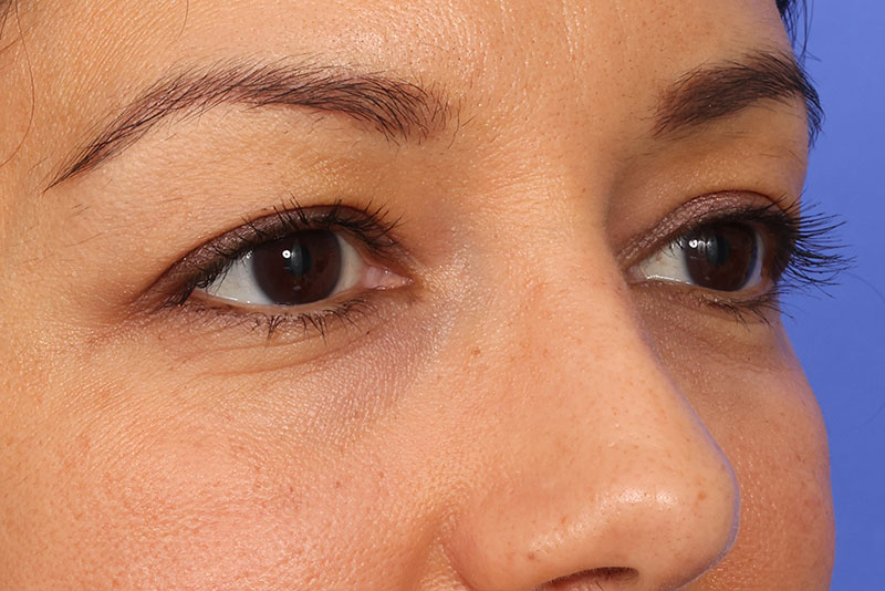 Eyelid Surgery Before & After Image