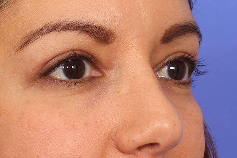 Eyelid Surgery Before & After Image