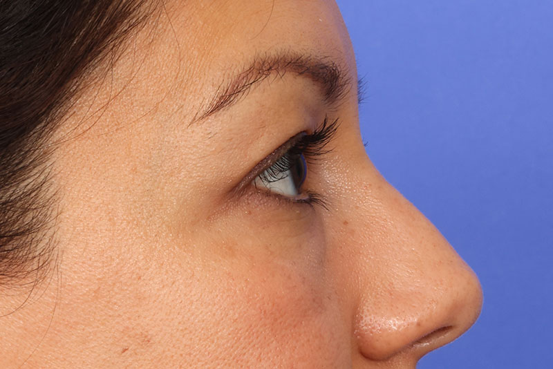 Eyelid Surgery Before & After Image