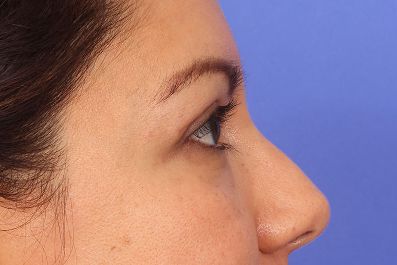 Eyelid Surgery Before & After Image