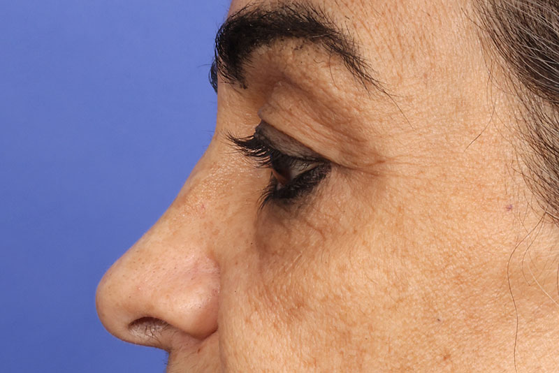 Eyelid surgery Before & After Image