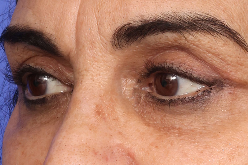 Eyelid Surgery Before & After Image