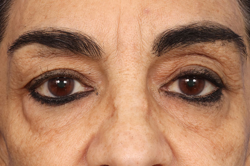 Eyelid Surgery Before & After Image