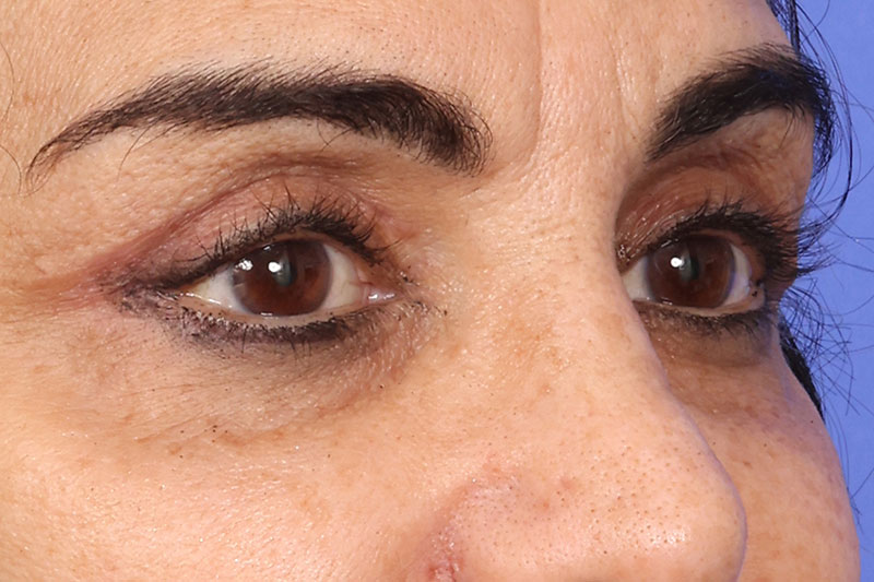 Eyelid Surgery Before & After Image