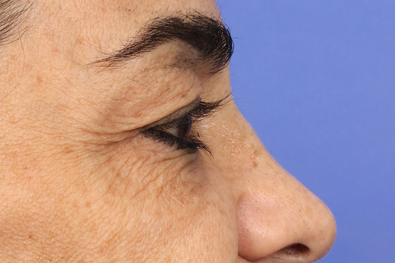 Eyelid Surgery Before & After Image